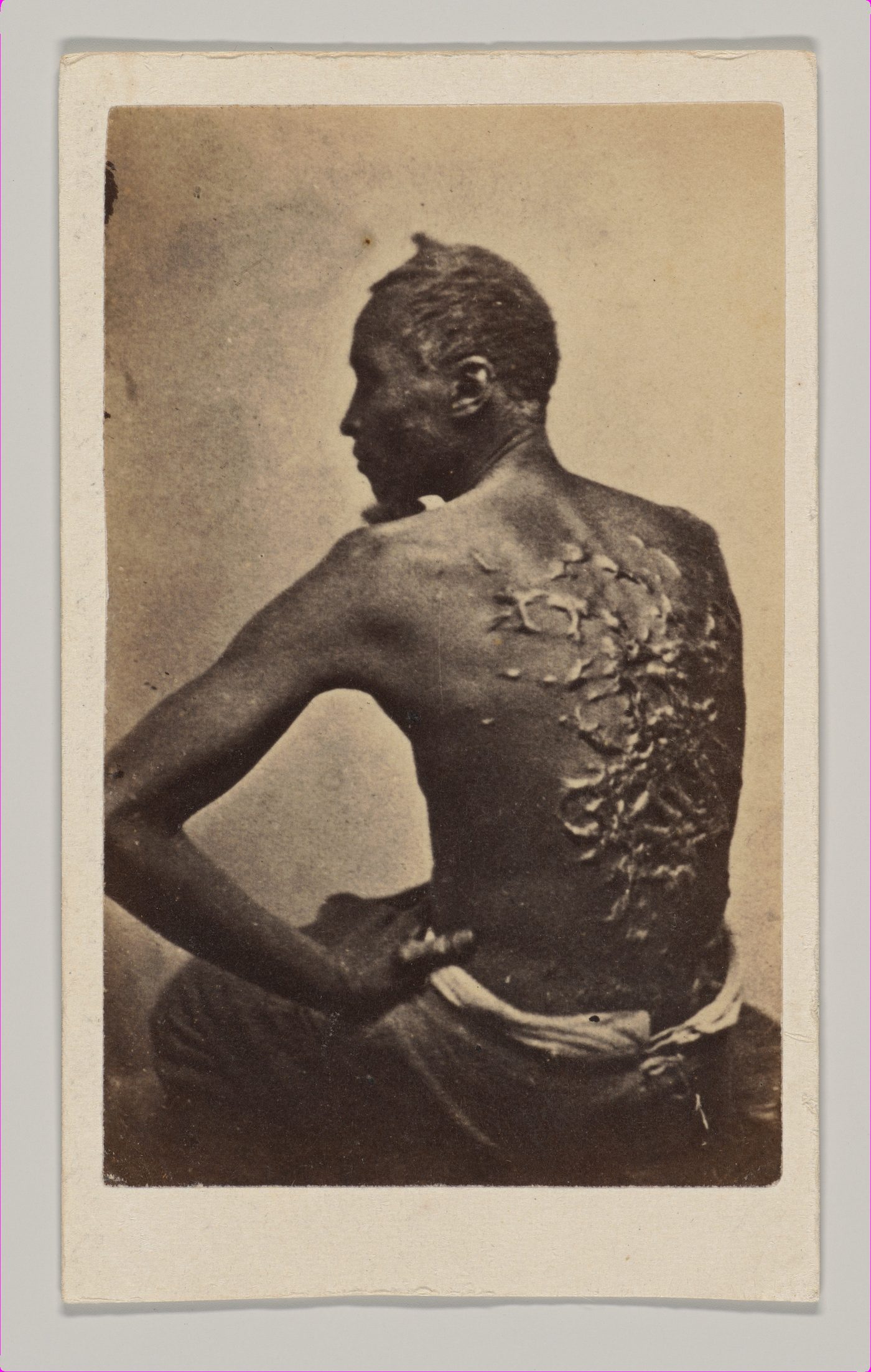A photograph of a seated Black man seen from behind, shirtless, his back covered with thick raised scars from whipping, his left hand on his hip
